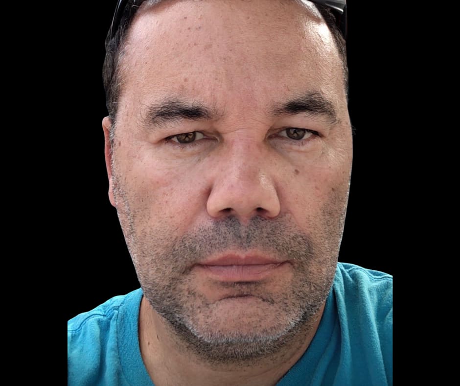 A patient's face before and after full-face harmonization.