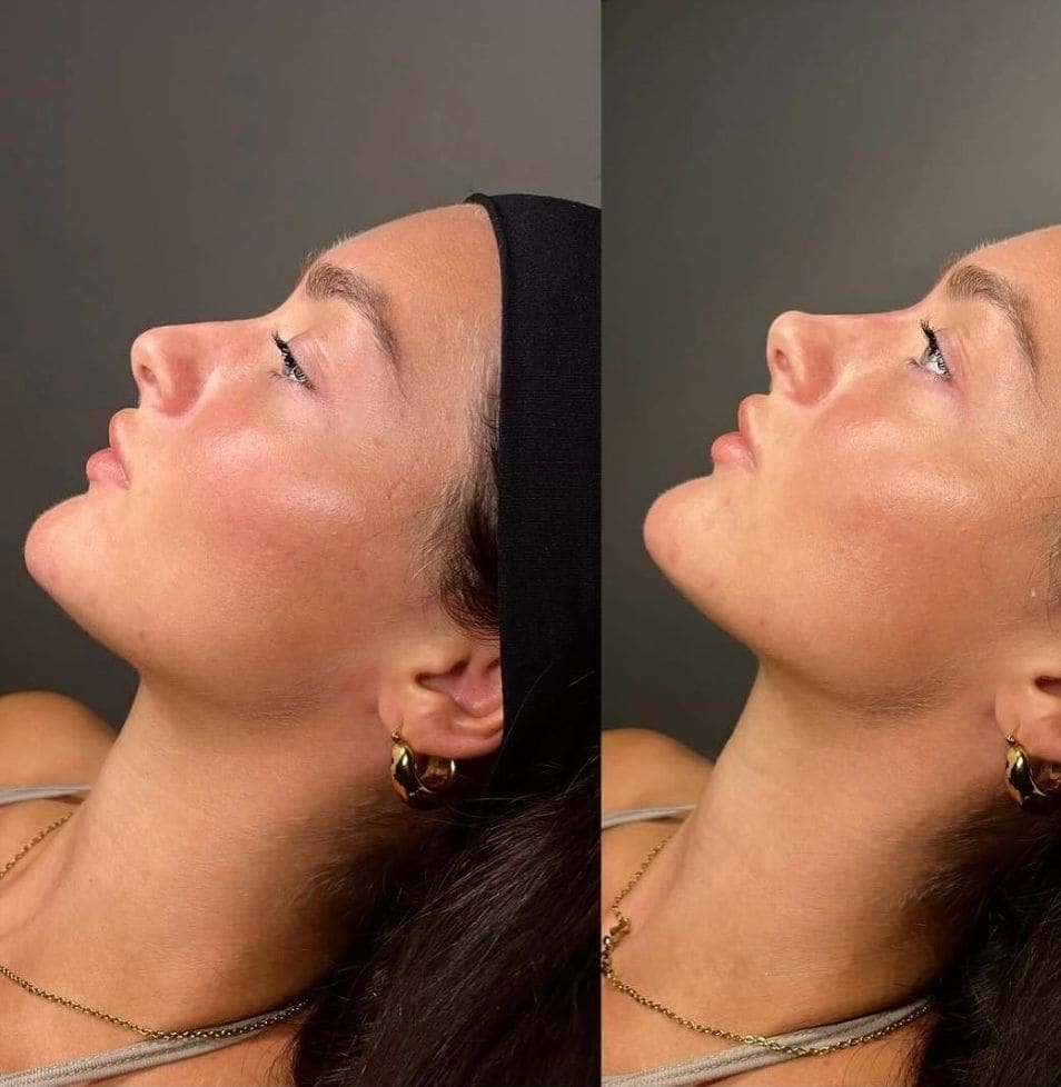 Side-by-side profile view of a patient's jawline and chin, before and after treatment.