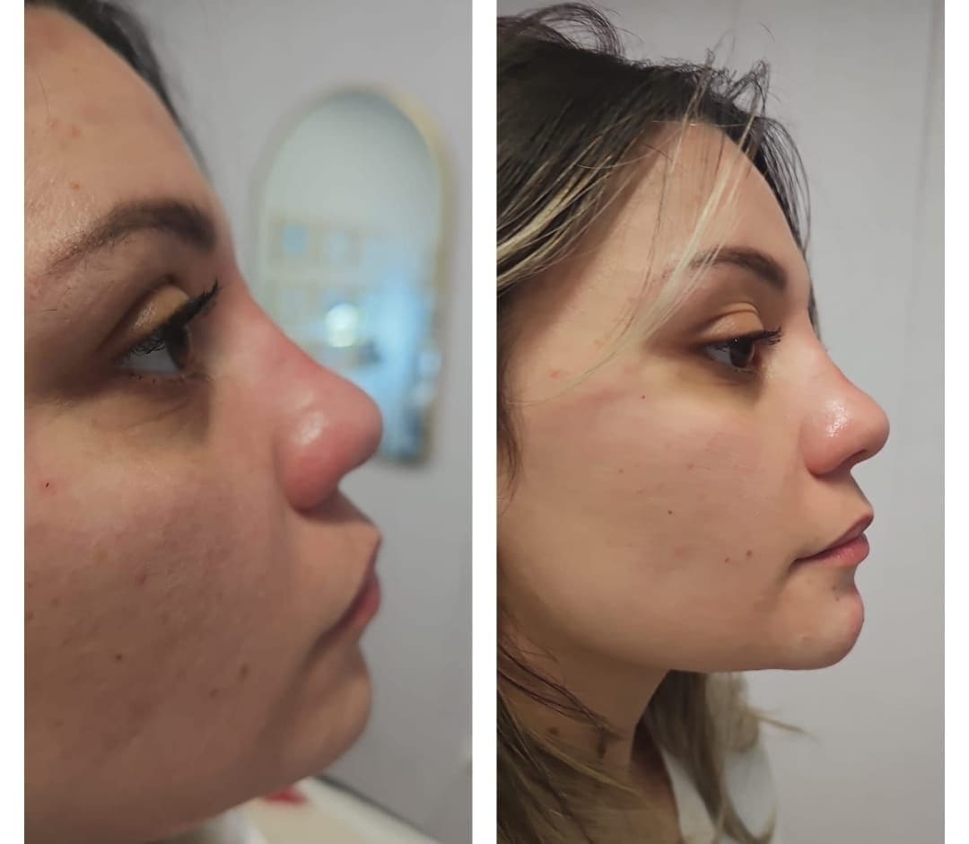 Side-by-side profile view of a patient's nose and cheek, before and after treatment.